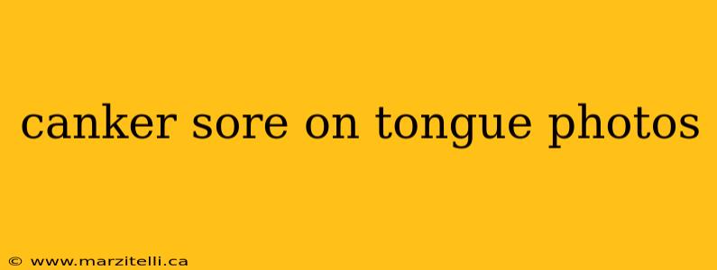 canker sore on tongue photos