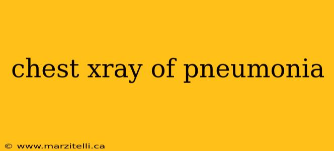 chest xray of pneumonia